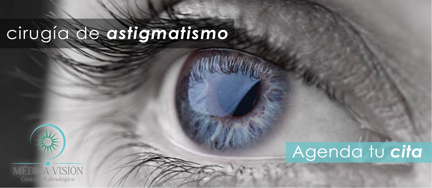 Transplante de córnea o queratoplastia 